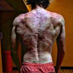www.znewsservice.com mans viral warning severe pain and scarring caused by steroids jam press jmp321563