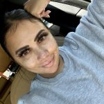 www.znewsservice.com womans disturbing experience with buccal fat removal sparks warning against procedure jam press jmp318063