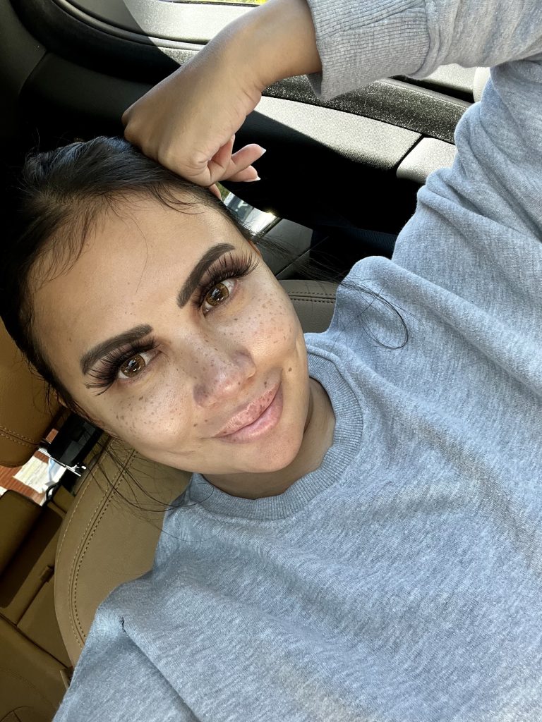 www.znewsservice.com womans disturbing experience with buccal fat removal sparks warning against procedure jam press jmp318063
